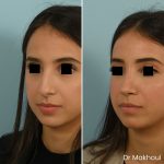 Avant Apres Rhinoplastie Bosse Cas48 2