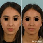 Avant Apres Rhinoplastie Bosse Cas48 3