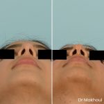 Avant Apres Rhinoplastie Bosse Cas48 4