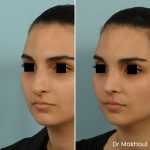 Avant Apres Rhinoplastie Bosse Nez Cas47 2
