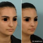 Avant Apres Rhinoplastie Bosse Nez Cas47 3