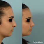 Avant Apres Rhinoplastie Bosse Nez Cas47 4