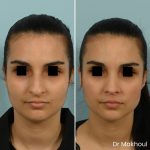 Avant Apres Rhinoplastie Bosse Nez Cas47 5