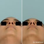 Avant Apres Rhinoplastie Bosse Nez Cas47 6