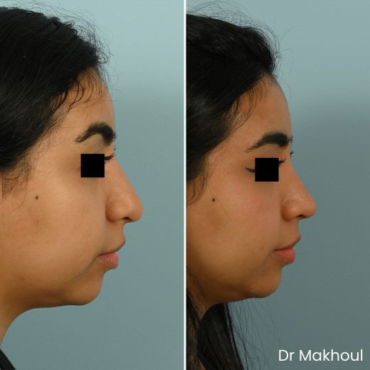 Avant Apres Rhinoplastie Bosse Nez Cas49 1