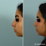 Avant Apres Rhinoplastie Bosse Nez Cas49 2