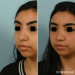 Avant Apres Rhinoplastie Bosse Nez Cas49 3