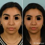 Avant Apres Rhinoplastie Bosse Nez Cas49 4