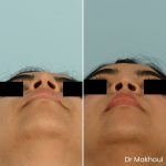 Avant Apres Rhinoplastie Bosse Nez Cas49 5