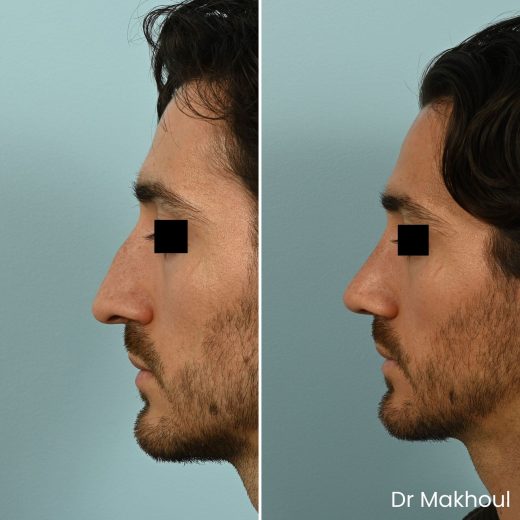 Avant Apres Rhinoplastie Bosse Nez Cas50 1