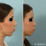 Avant Apres Rhinoplastie Bosse Nez Cas53 2