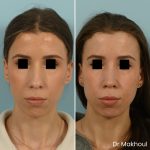 Avant Apres Rhinoplastie Bosse Nez Cas53 3