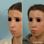 Avant Apres Rhinoplastie Bosse Nez Cas53 4