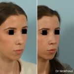 Avant Apres Rhinoplastie Bosse Nez Cas53 5
