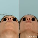 Avant Apres Rhinoplastie Bosse Nez Cas53 6