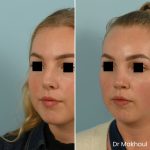 Avant Apres Rhinoplastie Bosse Nez Cas54 2