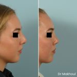 Avant Apres Rhinoplastie Bosse Nez Cas54 3