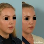 Avant Apres Rhinoplastie Bosse Nez Cas54 4