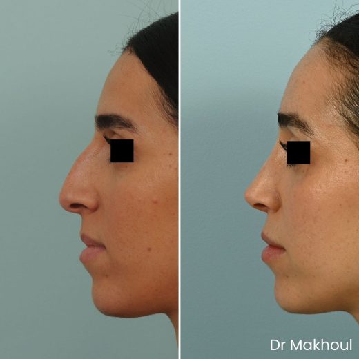 Avant Apres Rhinoplastie Bosse Nez Cas55 1
