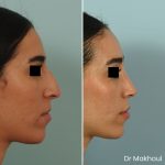 Avant Apres Rhinoplastie Bosse Nez Cas55 2
