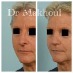 Avant Apres Rhinoplastie Homme Cas16b 2