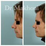 Avant Apres Rhinoplastie Homme Cas17 2