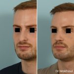 Avant Apres Rhinoplastie Homme Cas18 4