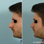 Avant Apres Rhinoplastie Homme Cas20 2