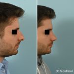 Avant Apres Rhinoplastie Homme Cas20 4