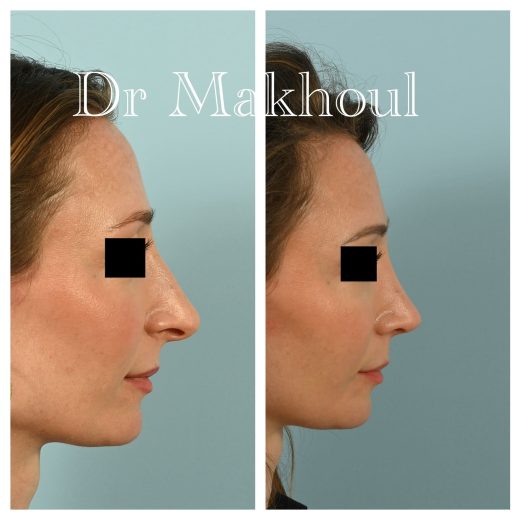 Avant Apres Rhinoplastie Narines Cas10 1