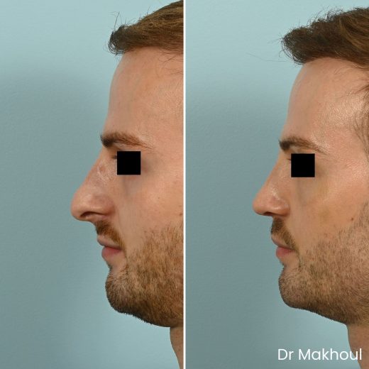 Avant Apres Rhinoplastie Narines Cas15 1