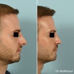 Avant Apres Rhinoplastie Narines Cas15 2