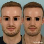 Avant Apres Rhinoplastie Narines Cas15 3