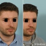Avant Apres Rhinoplastie Nez Devie Cas11 3