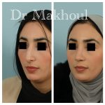 Avant Apres Rhinoplastie Nez Devie Cas9 2