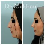 Avant Apres Rhinoplastie Nez Devie Cas9 3