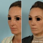 Avant Apres Rhinoplastie Pointe Cas32 2