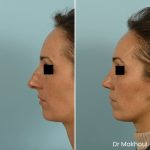 Avant Apres Rhinoplastie Pointe Cas32 3