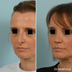 Avant Apres Rhinoplastie Pointe Cas33 2