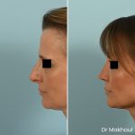 Avant Apres Rhinoplastie Pointe Cas33 3