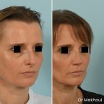 Avant Apres Rhinoplastie Pointe Cas33 4
