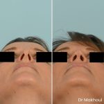 Avant Apres Rhinoplastie Pointe Cas33 5