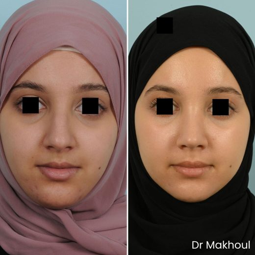 Avant Apres Rhinoplastie Pointe Cas38 1