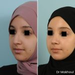 Avant Apres Rhinoplastie Pointe Cas38 2