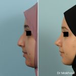 Avant Apres Rhinoplastie Pointe Cas38 3