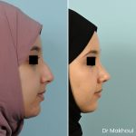 Avant Apres Rhinoplastie Pointe Cas38 4