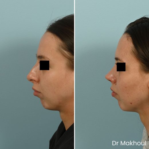 Avant Apres Rhinoplastie Pointe Nez Cas34 1