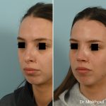 Avant Apres Rhinoplastie Pointe Nez Cas34 2