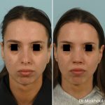Avant Apres Rhinoplastie Pointe Nez Cas34 3